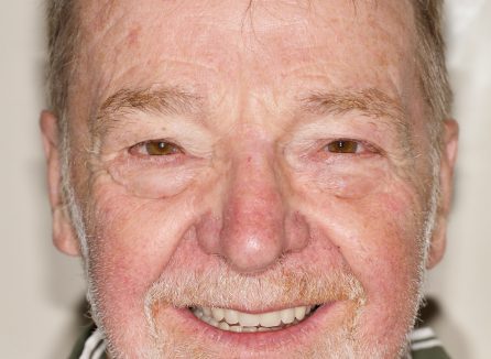 Implant-retained overdenture ‘best of both worlds’ for management and maintenance – Dr Marcus Gambroudes