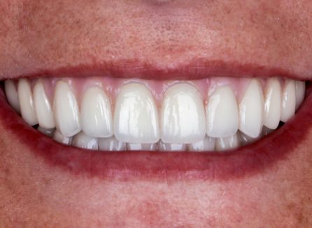 Digitally panned full-arch, implant-supported restoration for immediate function and aesthetics – Dr Usman Riaz
